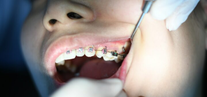 person with silver teeth braces